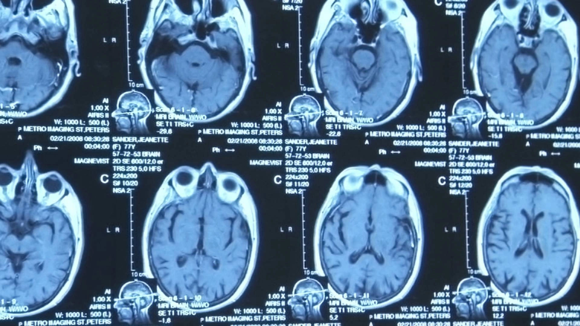 The Alzheimer's Project